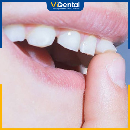 Răng lung lay không chỉ xảy ra ở trẻ trong độ tuổi thay răng 