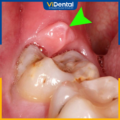 Sưng mộng răng là sự xuất hiện của các ổ mủ dưới nướu