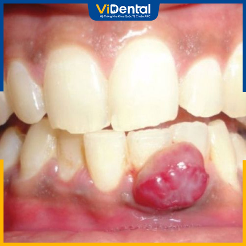 Vị trí quanh chân răng sưng to và gây đau nhức rõ rệt