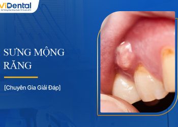 Sưng Mộng Răng: Nguyên Nhân, Triệu Chứng Và Cách Điều Trị