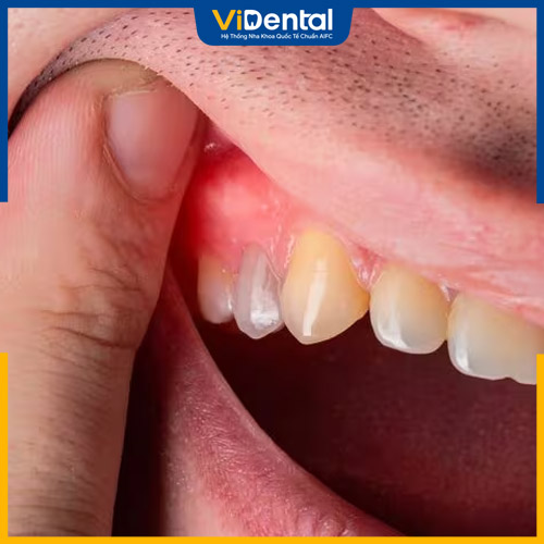 Nướu dễ bị sưng đỏ đau nhức, thậm chí chảy máu