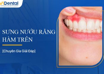 Sưng Nướu Răng Hàm Trên: Nguyên nhân, Cách Chữa Hiệu Quả