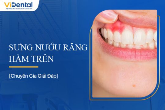 Sưng Nướu Răng Hàm Trên: Nguyên nhân, Cách Chữa Hiệu Quả