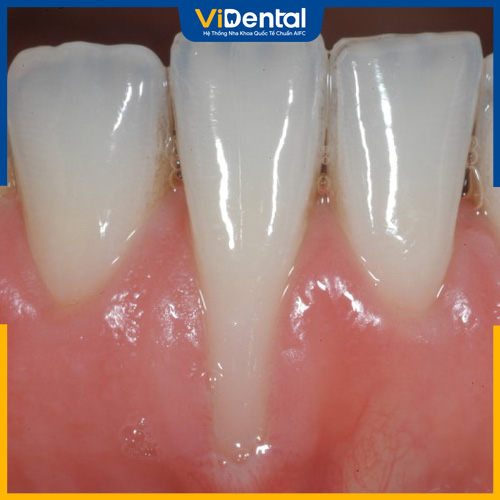Phần nướu lộ chân răng rõ rệt