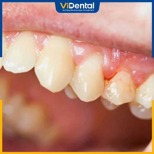 Viêm lợi có thể gây ra tụt nướu