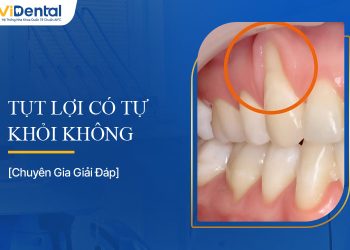 Tụt Lợi Có Tự Khỏi Không? Tìm Hiểu Nguyên Nhân, Cách Điều Trị