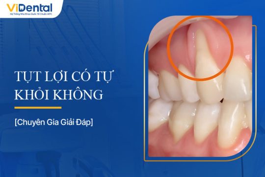 Tụt Lợi Có Tự Khỏi Không? Tìm Hiểu Nguyên Nhân, Cách Điều Trị
