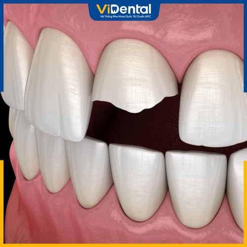 Răng bị mẻ là tình trạng răng bị nứt hoặc gãy