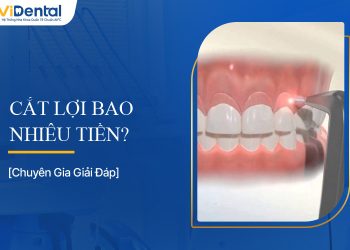 Cắt Lợi Bao Nhiêu Tiền? Tất Tần Tật Về Chi Phí Và Quy Trình