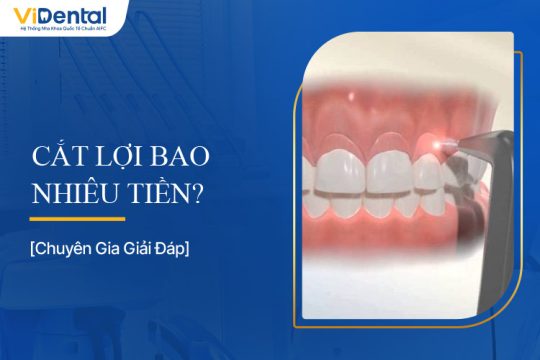 Cắt Lợi Bao Nhiêu Tiền? Tất Tần Tật Về Chi Phí Và Quy Trình