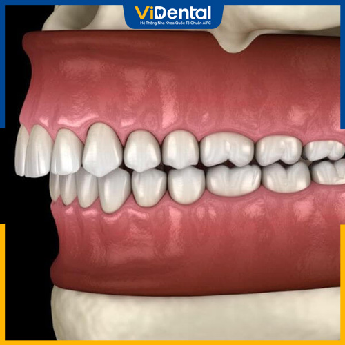 Khớp cắn sâu là tình trạng hàm trên che phủ hàm dưới quá mức