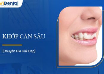 Khớp Cắn Sâu Là Gì? Làm Sao Để Cải Thiện Khớp Cắn?