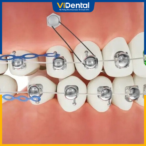 Mắc cài cánh cam được sử dụng rất phổ biến tại các nha khoa