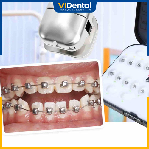 Loại mắc cài này giúp quá trình niềng răng nhanh chóng hơn