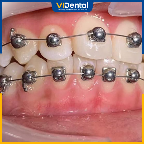 Cần lựa chọn cơ sở nha khoa uy tín