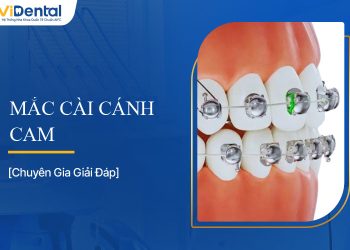 Tìm Hiểu Chi Tiết Mắc Cài Cánh Cam - Có Nên Sử Dụng Không?