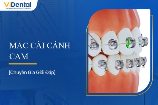 Tìm Hiểu Chi Tiết Mắc Cài Cánh Cam - Có Nên Sử Dụng Không?