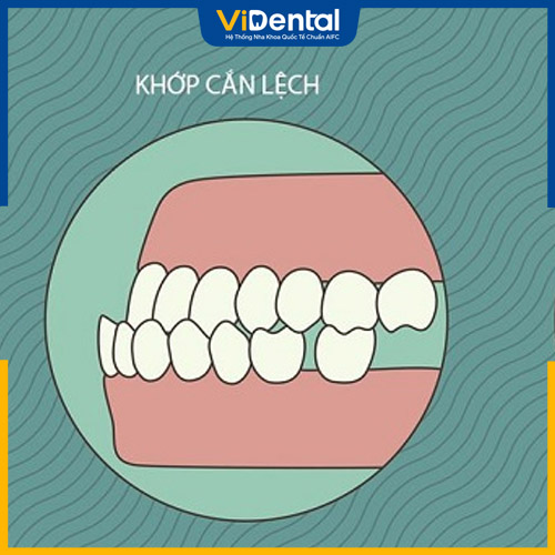 Lệch khớp hàm là nguyên nhân thường gặp