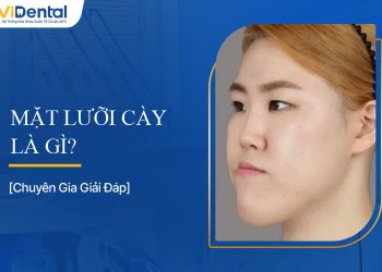 Mặt Lưỡi Cày Là Gì? Tìm Hiểu Chi Tiết - Nha Khoa ViDental