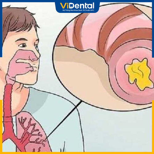 Nuốt đờm có sao không? Thực tế không gây nguy hiểm