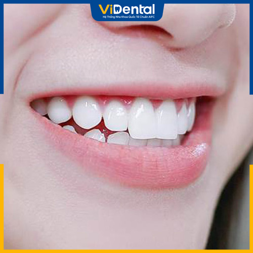 Răng thỏ là 2 răng cửa nhô ra phía trước
