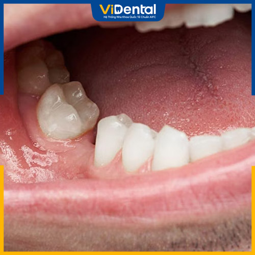 Tiêu xương răng là xương quanh chân răng bị mất 