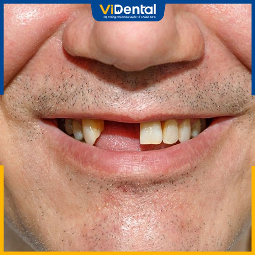Mất răng trong thời gian dài dễ gây ra tiêu xương răng