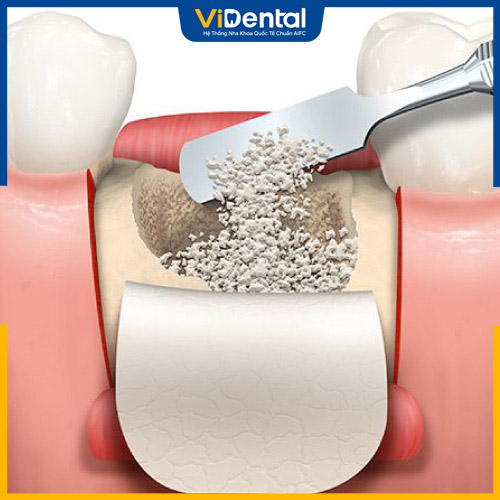 Trường hợp nghiêm trọng sẽ cần thực hiện ghép xương