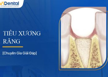 Tiêu Xương Răng: Nguyên Nhân, Dấu Hiệu Và Cách Điều Trị