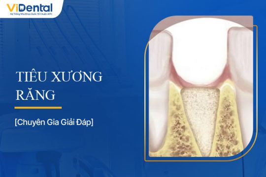 Tiêu Xương Răng: Nguyên Nhân, Dấu Hiệu Và Cách Điều Trị